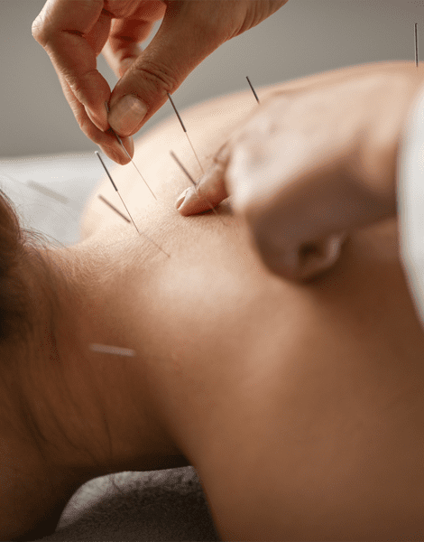 acupuncture